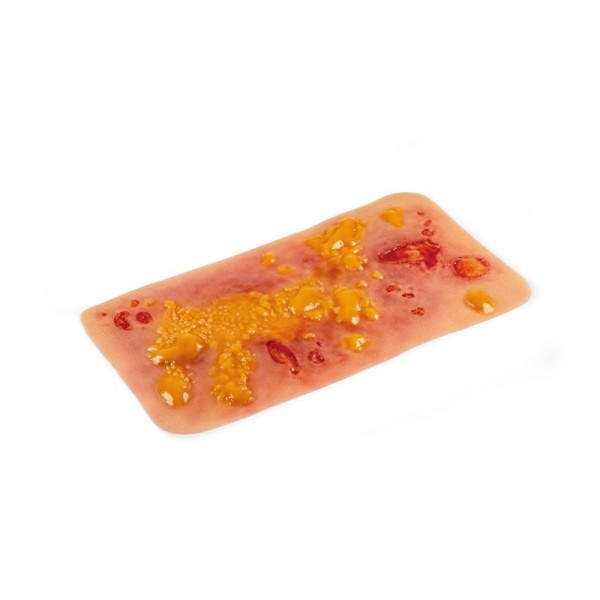 Wound Moulage "2nd Degree Burn" – Προσομοίωση Εγκαύματος 2ου Βαθμού 2