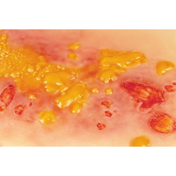 Wound Moulage "2nd Degree Burn" – Προσομοίωση Εγκαύματος 2ου Βαθμού 2