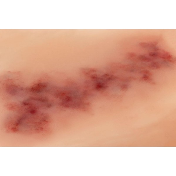 Wound Moulage "Hematoma Older" – Προσομοίωση Παλαιού Αιματώματος