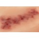 Wound Moulage "Hematoma Older" – Προσομοίωση Παλαιού Αιματώματος