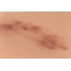 Wound Moulage "Fresh Hematoma" – Προσομοίωση Φρέσκου Αιματώματος