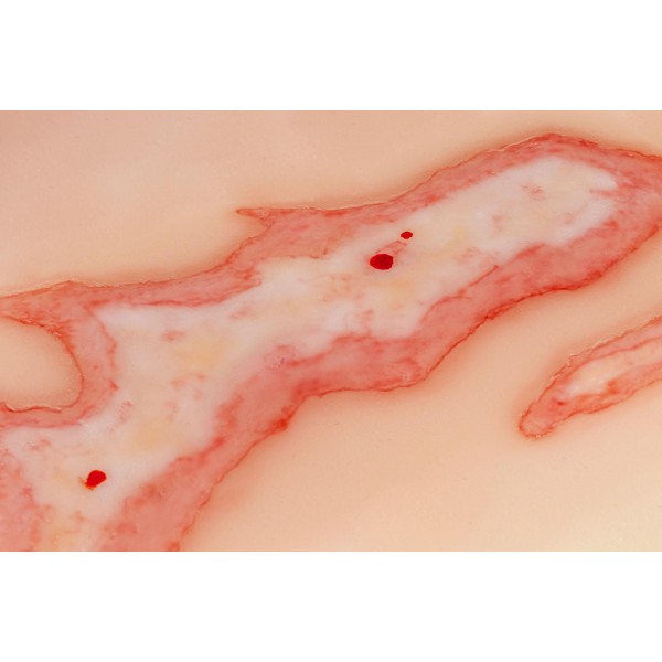 Wound Moulage "Scalding" – Προσομοίωση Εγκαύματος από Ζεστό Υγρό 2