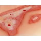 Wound Moulage "Scalding" – Προσομοίωση Εγκαύματος από Ζεστό Υγρό