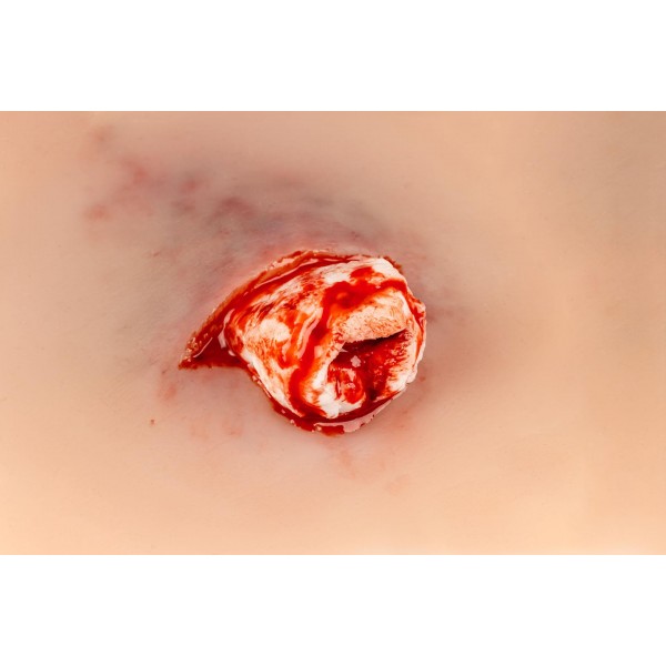 Wound Presentation "Open Fracture Ankle Joint" – Προσομοίωση Ανοικτού Κατάγματος στην Άρθρωση του Αστραγάλου