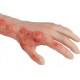 Arm with Burns Task Trainer – Εκπαιδευτικό Μοντέλο Χεριού με Εγκαύματα