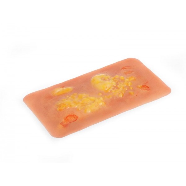 Wound Moulage "2nd Degree Burn" – Προσομοίωση Εγκαύματος 2ου Βαθμού Wound Moulage "2nd Degree Burn" – Προσομοίωση Εγκαύματος 2ου Βαθμού