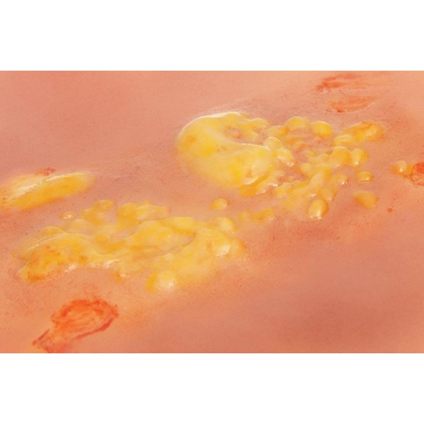 Wound Moulage "2nd Degree Burn" – Προσομοίωση Εγκαύματος 2ου Βαθμού Wound Moulage "2nd Degree Burn" – Προσομοίωση Εγκαύματος 2ου Βαθμού