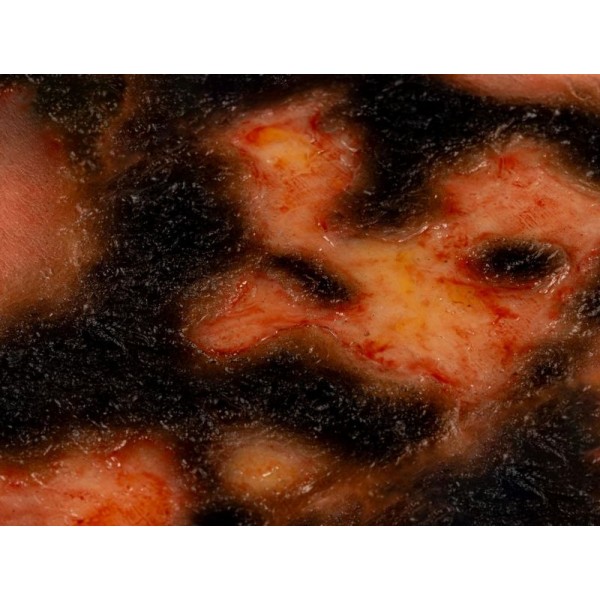 Wound Moulage "3rd Degree Burn" – Προσομοίωση Εγκαύματος 3ου Βαθμού Wound Moulage "3rd Degree Burn" – Προσομοίωση Εγκαύματος 3ου Βαθμού