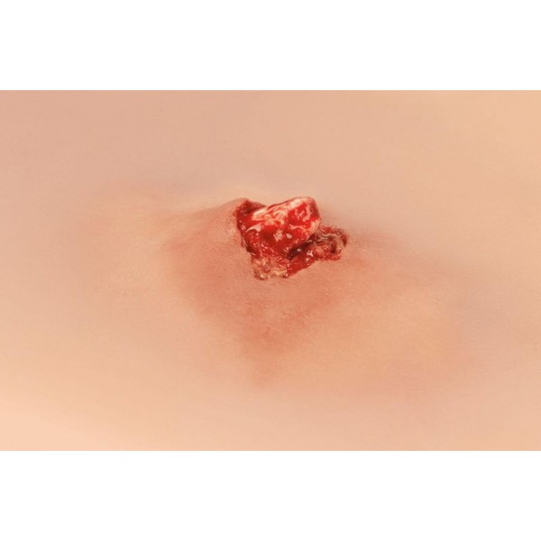 Wound Moulage – Ανοιχτό Κάταγμα Οστού Άνω Άκρου με Λειτουργία Αιμορραγίας