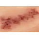 Wound Moulage "Hematoma Older" – Προσομοίωση Παλαιού Αιματώματος Wound Moulage "Hematoma Older" – Προσομοίωση Παλαιού Αιματώματος