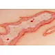 Wound Moulage "Scalding" – Προσομοίωση Εγκαύματος από Ζεστό Υγρό 2 Wound Moulage "Scalding" – Προσομοίωση Εγκαύματος από Ζεστό Υγρό 2
