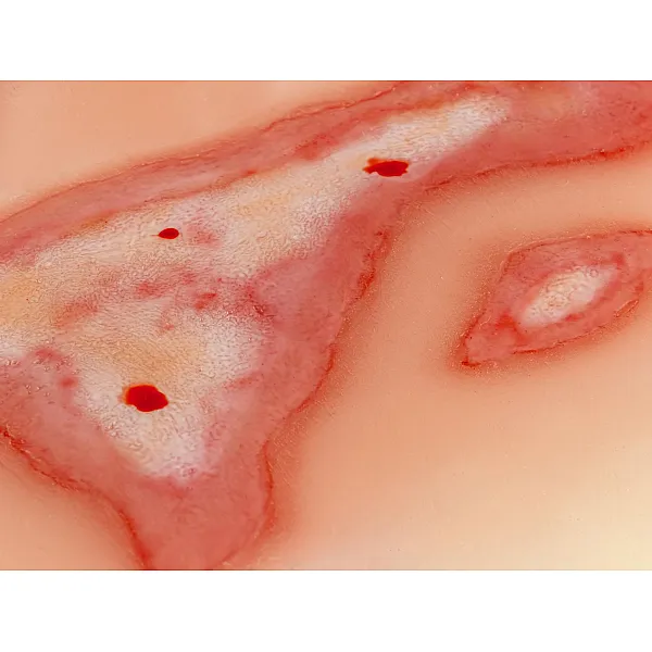 Wound Moulage "Scalding" – Προσομοίωση Εγκαύματος από Ζεστό Υγρό Wound Moulage "Scalding" – Προσομοίωση Εγκαύματος από Ζεστό Υγρό
