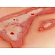 Wound Moulage "Scalding" – Προσομοίωση Εγκαύματος από Ζεστό Υγρό