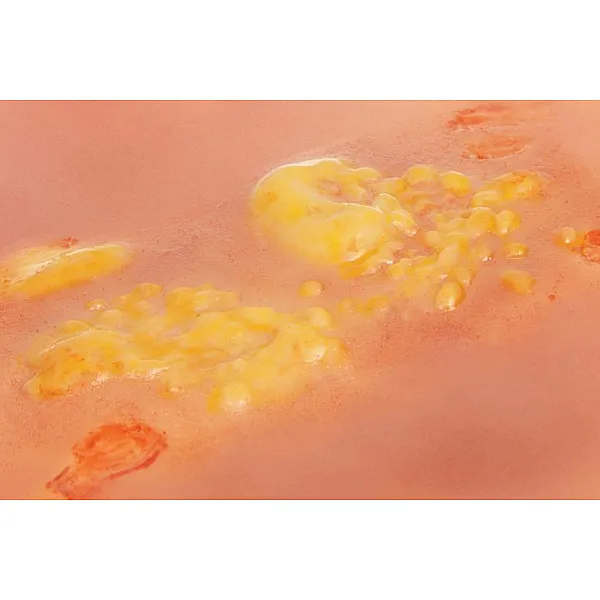 Wound Moulage "2nd Degree Burn" – Προσομοίωση Εγκαύματος 2ου Βαθμού