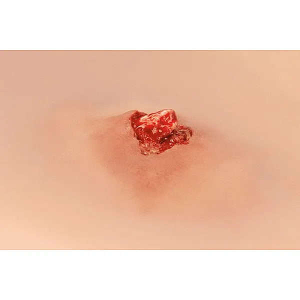 Wound Moulage – Ανοιχτό Κάταγμα Οστού Άνω Άκρου με Λειτουργία Αιμορραγίας